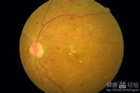 導致視網膜病變的常見疾病有哪些