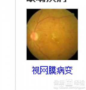 視網膜病變是否能做手術