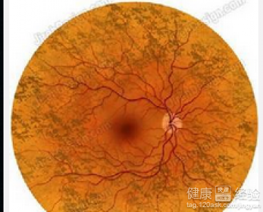 如何預防中心漿液性視網膜病