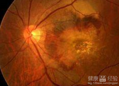 如何預防中心性漿液性視網膜病