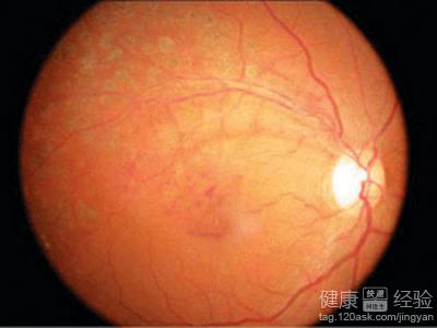 視網膜病變要怎麼去醫治