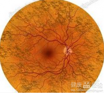 糖尿病視網膜病變會導致失明嗎