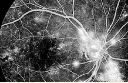 中心性視網膜病變應注意什麼