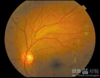 高血壓會引起的視網膜病變嗎