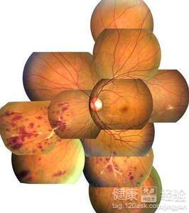 珠蛋白生成障礙性貧血視網膜病變症狀有哪些