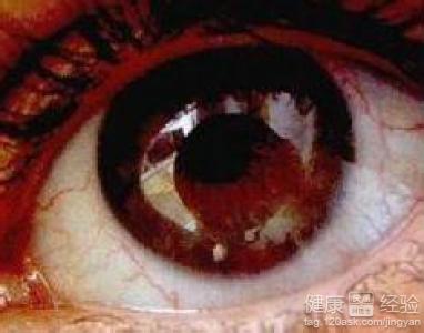 糖尿病視網膜病變吃什麼東西可以控制