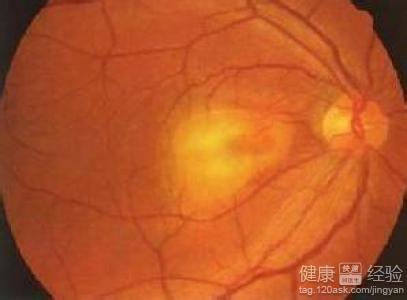 眼底視網膜病變如何護理