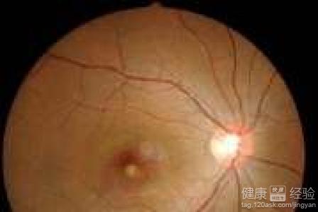 如何預防中心性脈絡膜視網膜病