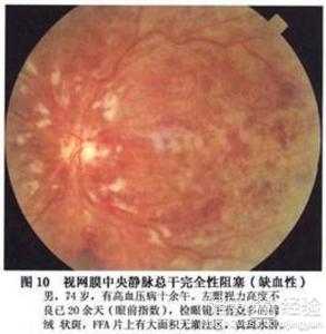 視網膜病變可以去打激光嗎