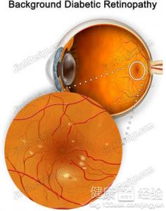 早產兒查眼睛視網膜病變該注意哪些