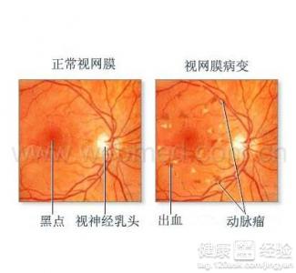 視網膜病變如何保持現時狀況