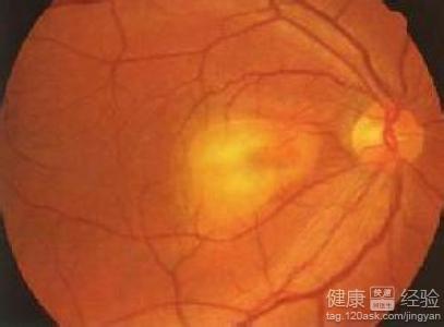 糖尿視網膜病變要做手術嗎