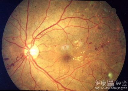 糖尿病視網膜病變最好去哪治療