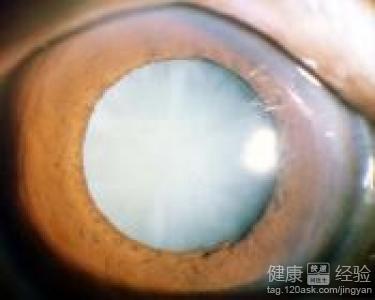 有視網膜病做白內障手術該注意什麼