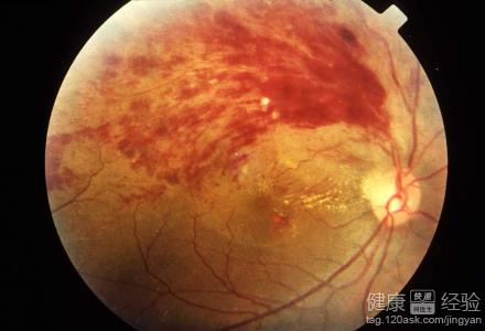我是遺傳性視網膜病中心型黃斑病變要怎麼治療