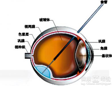 高血糖引起的視網膜病變，現在眼睛出血該怎麼辦呢