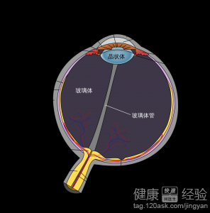 糖尿病引起的視網膜病變眼底出血怎麼辦呢