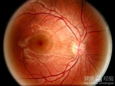我是右眼中性漿液視網膜病該怎麼治療