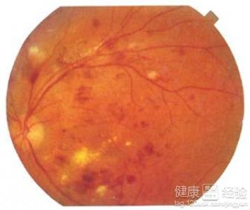 女性2型糖尿病有視網膜病變該怎麼治療