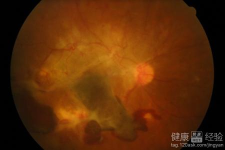 中心性漿液性視網膜病變視力下降怎麼辦