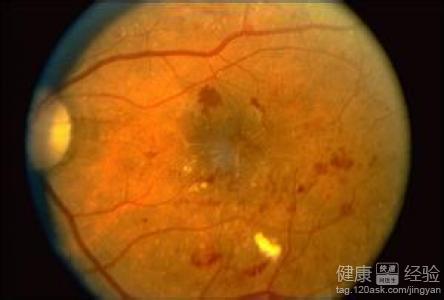 視網膜病變了有哪些治療方法呢