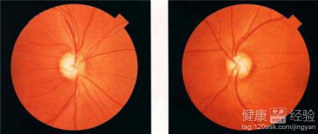 增生性玻璃體視網膜病變怎麼治療呢