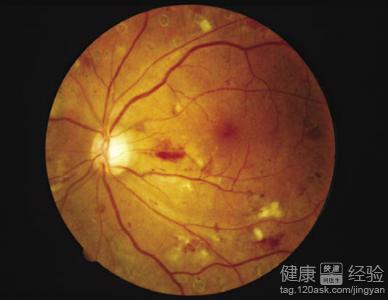 視網膜病變有斑點怎麼治
