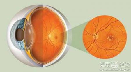 視網膜病變黃斑變性有什麼好的治療方法