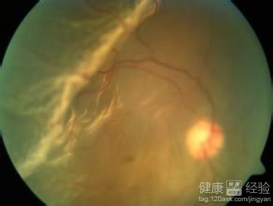右眼中心性漿液性脈絡膜視網膜病變怎麼辦
