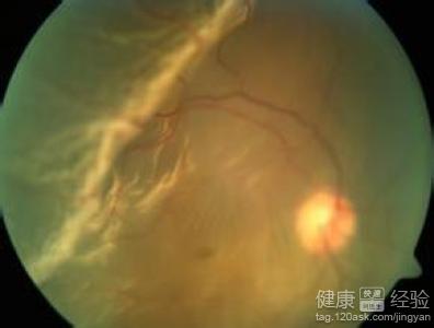 引起中心性漿液性脈絡膜視網膜病變的病因是什麼