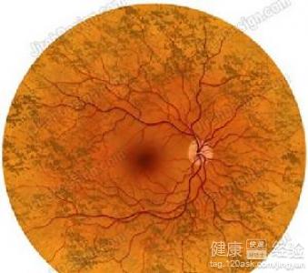 糖尿病引發視網膜病變，左眼即發性青光眼怎麼治療
