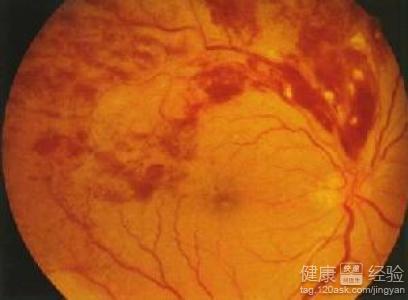 糖尿病眼底出血視網膜病變吃什麼藥比較好