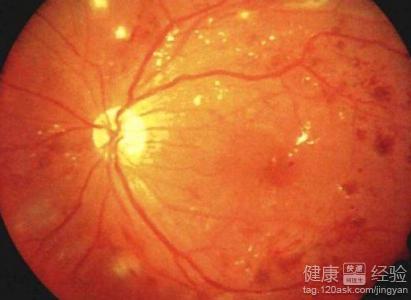 急性視網膜病變能治愈麼