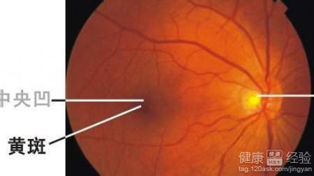 黃斑變性和視網膜病變怎樣通過手術治療