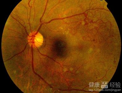 腎性視網膜病變有什麼好的藥物可以治療