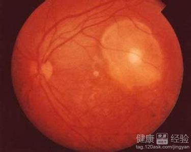 雙眼高血壓性視網膜病變如何護理