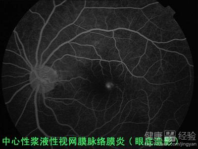 中心性漿液性視網膜病變如何治愈