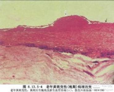 年齡相關性黃斑變性怎麼辦