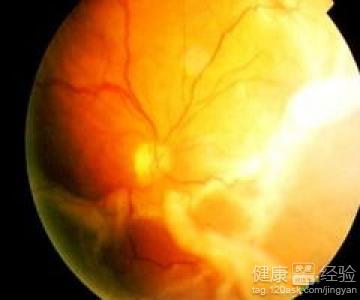 孔源性視網膜脫離怎麼辦