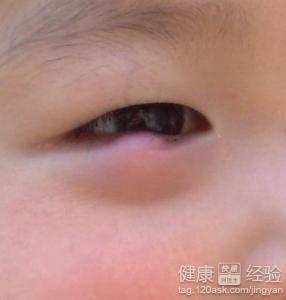 健康專家：孩子遠離“針眼”不是問題！