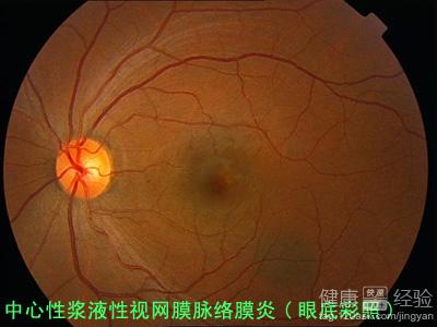 中心性滲出性脈絡膜視網膜病變怎麼辦