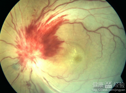 視網膜病如何日常防護？