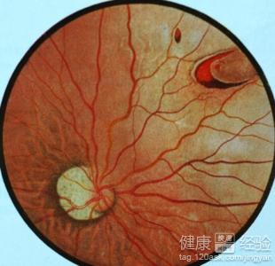 視網膜病——視網膜脫落應該如何預防？
