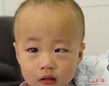麻痺性斜視的中醫治療方法