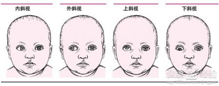 幾種內斜視的檢查方法