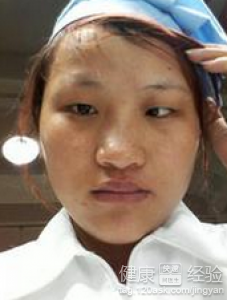 小兒斜視後天因素多