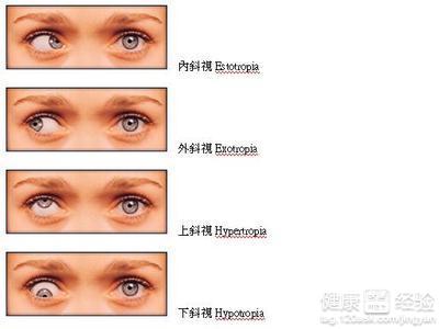 斜視的具體類型有什麼