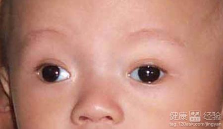 兒童斜視的原因有哪些小兒斜視的症狀