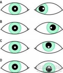 眨眼與斜視有哪些關系