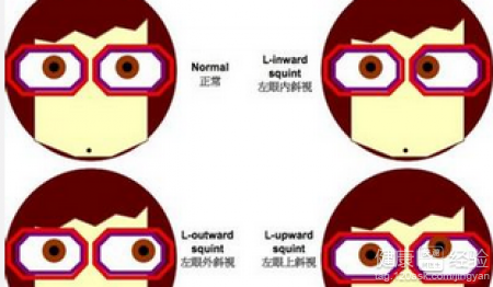 我眼睛屬於隱性斜視可以有哪些方法治療